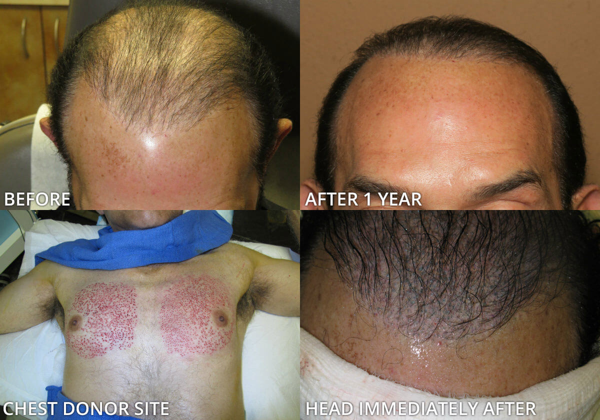 FUE Hair Transplantation – Before and After Pictures * | Dr Turowski