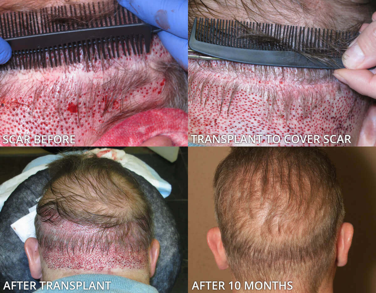 Before and after hair transplant Step-by-Step Situation - Desmoderm