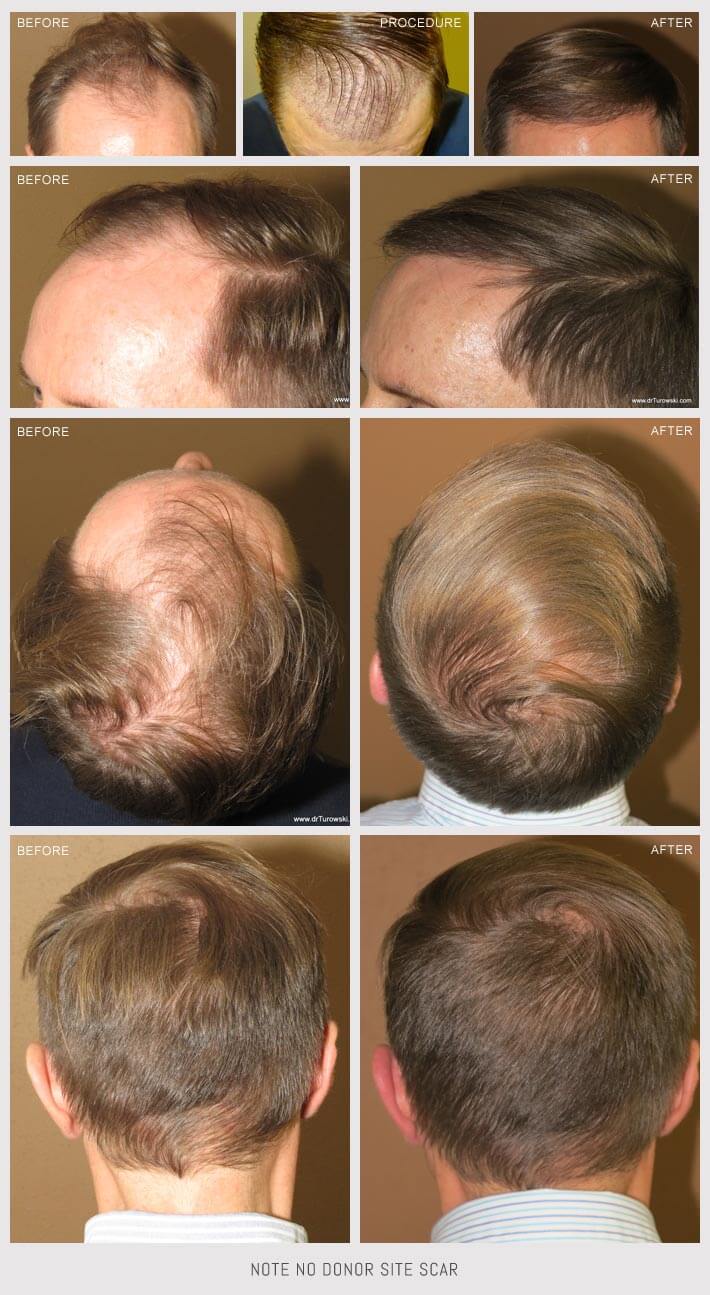 Hair Transplant Chicago - before and after pictures