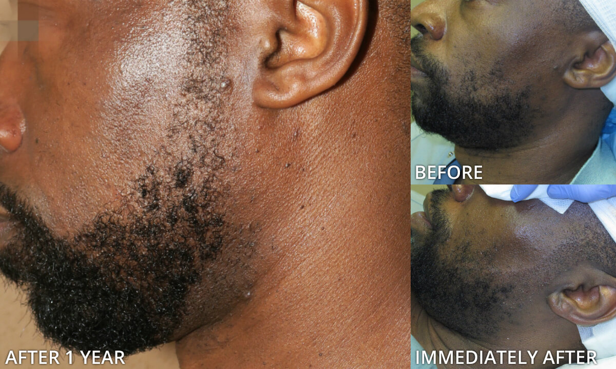Facial Hair Transplant - Before and After Pictures