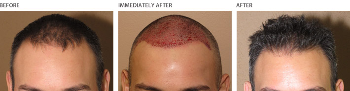 Hair Transplantation – Before and After Pictures