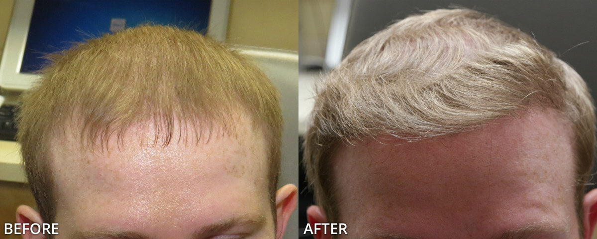 Пересадка волос нижний новгород. Пересадка волос блондин. До и после пересадки волос.