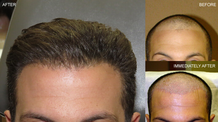 FUE Hair Transplantation – Before and After Pictures | Dr Turowski -  Plastic Surgery Chicago