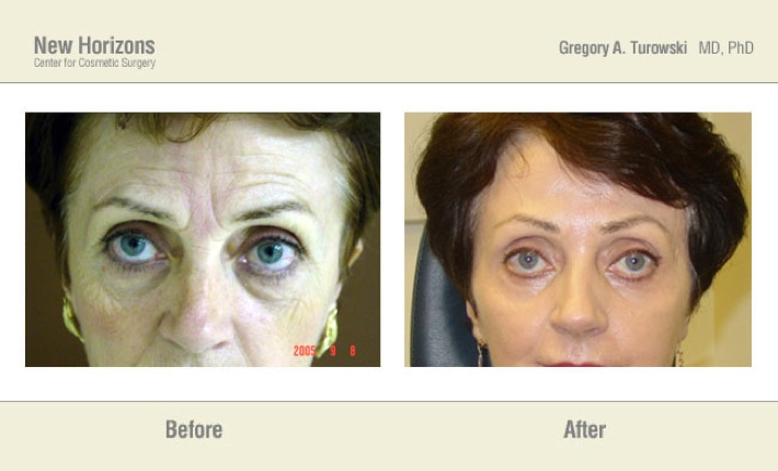 Laser resurfacing - Before and After Pictures