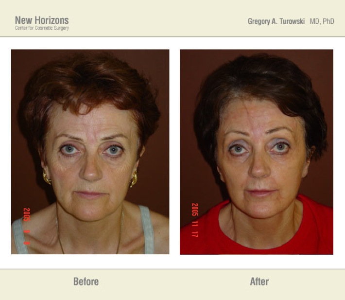 Laser resurfacing - Before and After Pictures