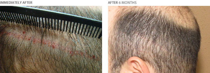 Linear scar after hair transplant using traditional FUT strip procedure is frequently a frustrating and devastating problem. We have been helping patients with visible scars utilizing FUE hair transplantation into the scar -either using Neograft or ARTAS robotic hair transplantation. Here is a photo of a patient immediately after follicular units transplants to the linear scar and phto 6 months after scar reconstruction and revision 