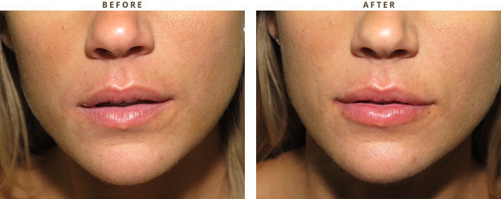 Lip lift - Before and After Pictures