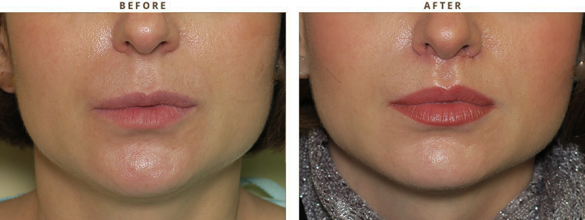 Lip Lift Before And After Pictures Dr Turowski Plastic Surgery Chicago