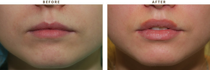 Lip lift - Before and After Pictures