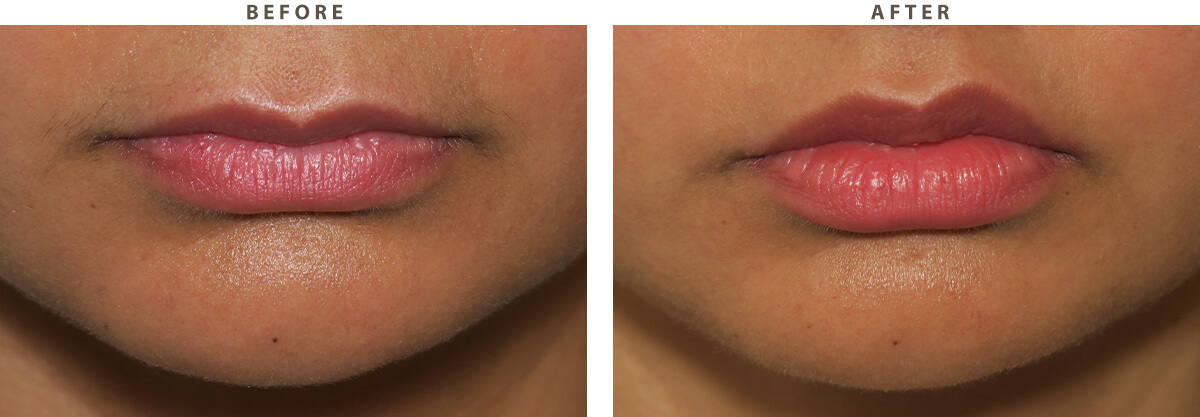 Lip Lift - Before and After Pictures