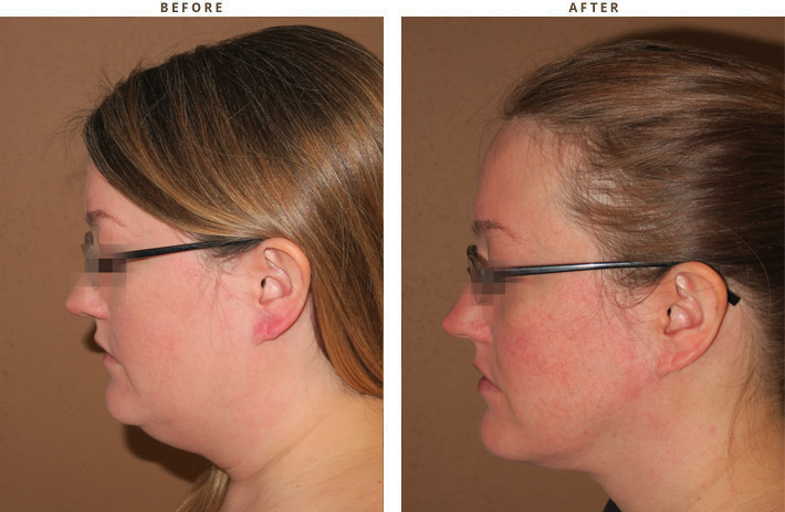 Liposuction Of The Neck Before And After Pictures Dr Turowski