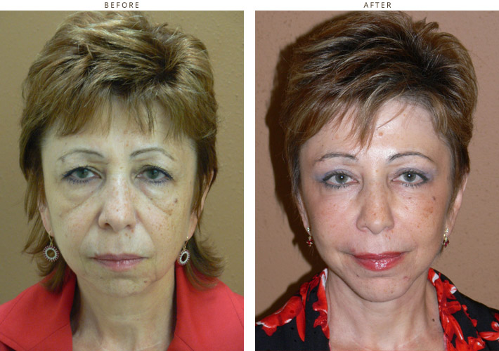 Mid Face Lift – Before and After Pictures