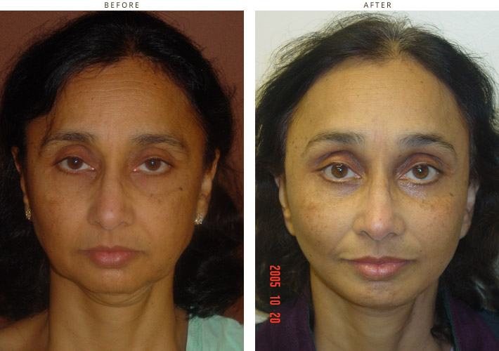 Mid Face Lift – Before and After Pictures