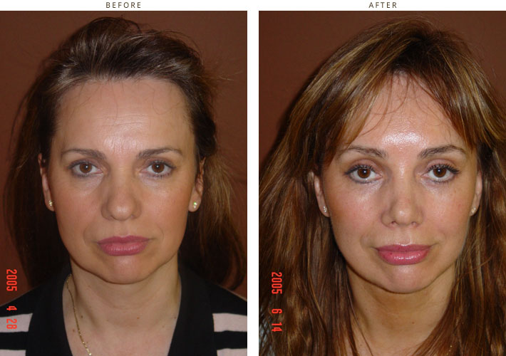 Mini Face Lift – Before and After Pictures * | Dr Turowski - Plastic