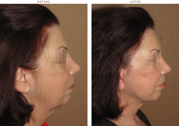 Mini Face Lift – Before and After Pictures