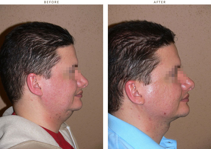 mini-face-lift-before-and-after-pictures-dr-turowski-plastic