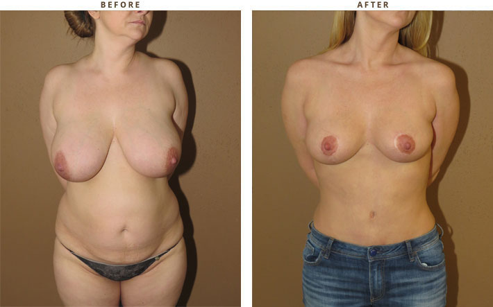 Breast Reduction - Before and After Pictures