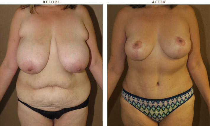 Breast Reduction - Before and After Pictures