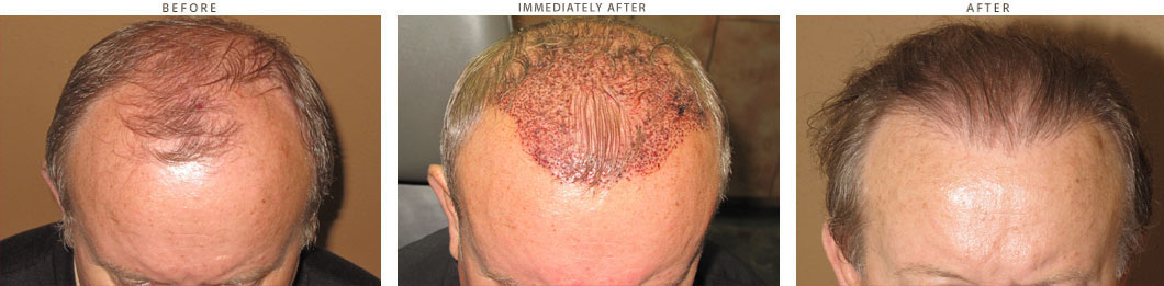 Neograft - hair transplantation - 2000 FUE