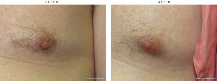 Nipple Reduction, Female & Male Nipple Reduction