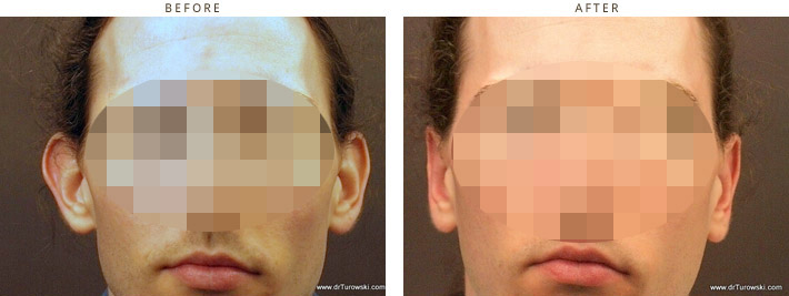 Otoplasty - Before & After Pictures