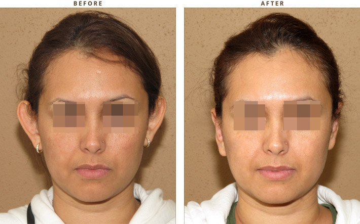Otoplasty - Before & After Pictures