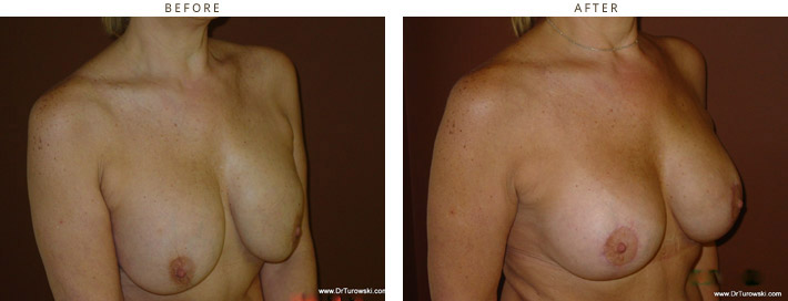 Revision Breast Surgery - Before and After Pictures