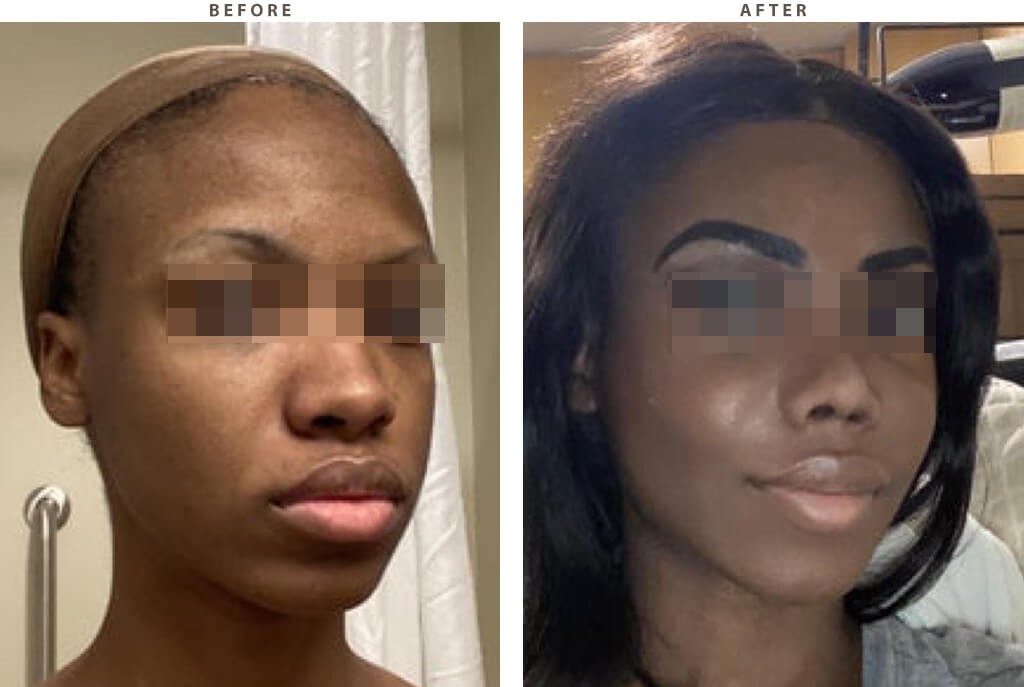 forehead implants before and after