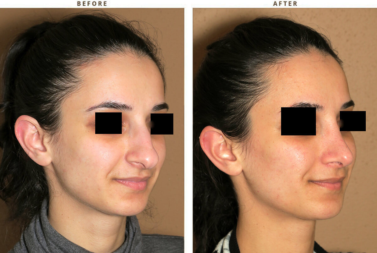 Rhinoplasty – Before and After Pictures 