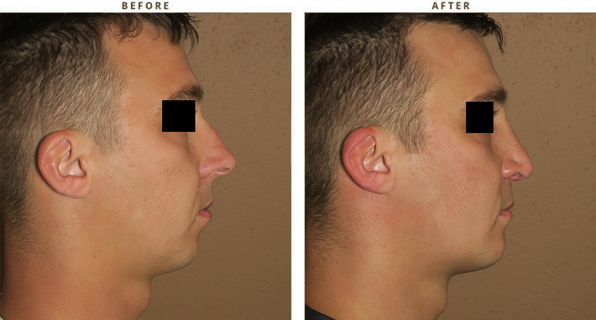 Chin augmentation and rhinoplasty – Before and After Pictures