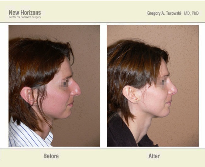 Rhinoplasty - Before and After Pictures