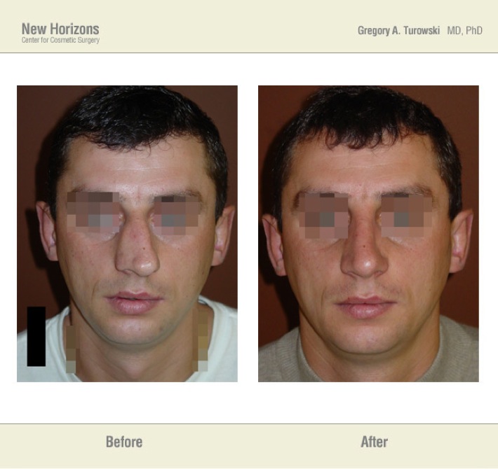 Rhinoplasty – Before and After Pictures