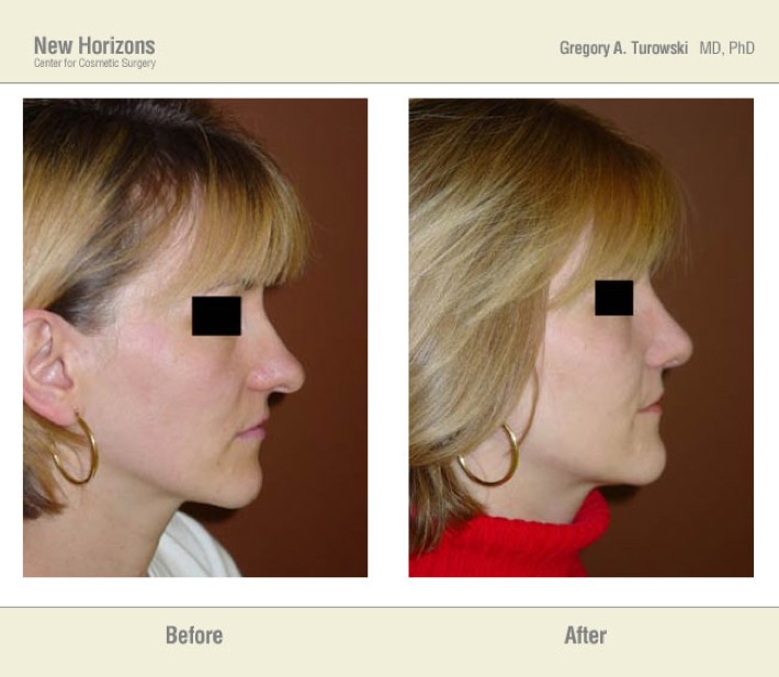 Rhinoplasty - Before and After Pictures