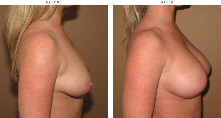 Scarless Internal Breast Lifting - Before and After Pictures