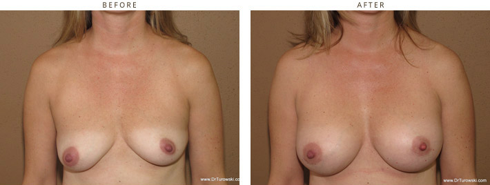 Breast Asymmetry – Before and After Pictures