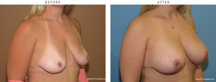 Scarless Internal Breast Lifting - Before and After Pictures