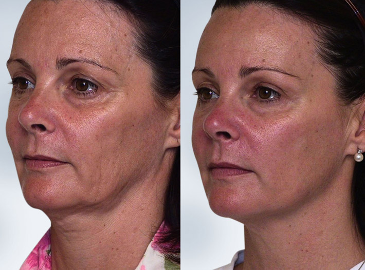 Sculptra - Before and After Pictures