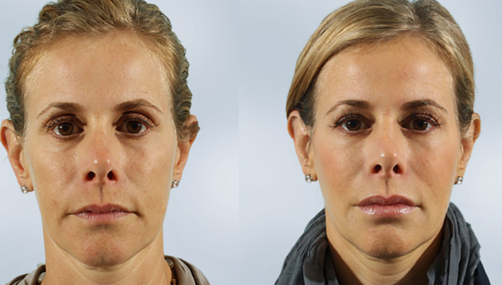 sculptra-before-and-after-02