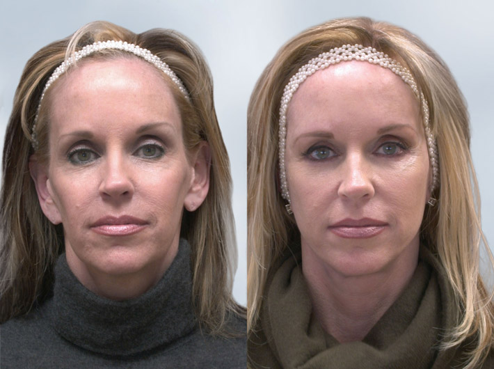 sculptra-before-and-after-03