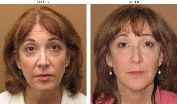 Sculptra - Before and After Pictures