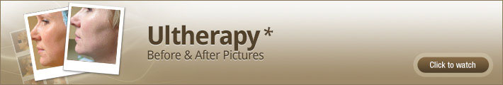 Ultherapy Chicago - before and after pictures
