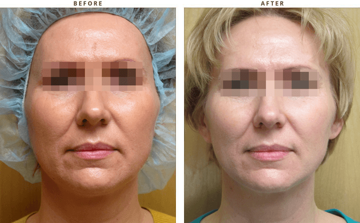 Ultherapy - Before and After Pictures