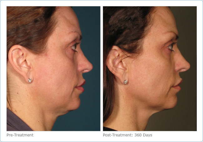 Ultherapy - Before & After Pictures