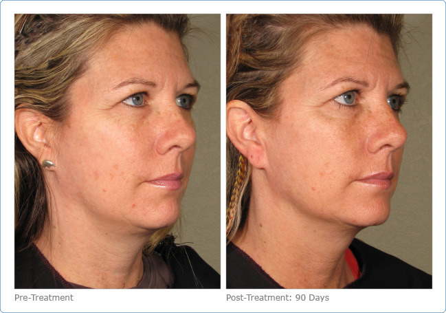 Ultherapy - Before & After Pictures