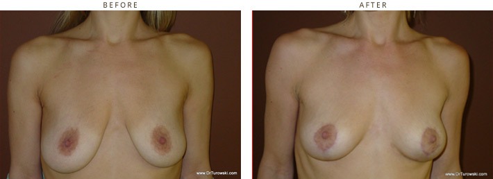 Vertical Mastopexy no implants - Before and After Pictures