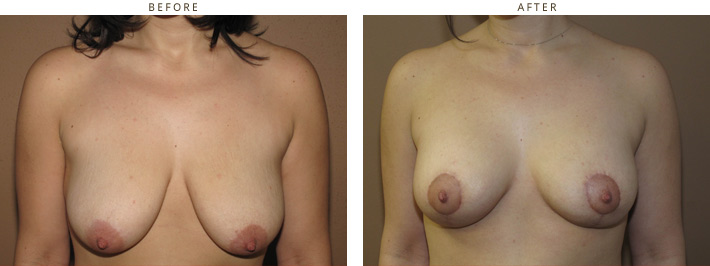 Breast Lift with implants - Before and After Pictures