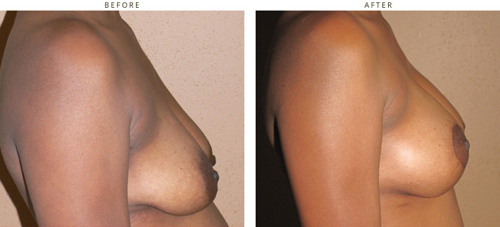 Breast Lift with implants - Before and After Pictures