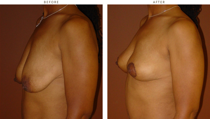 Vertical Mastopexy no implants - Before and After Pictures